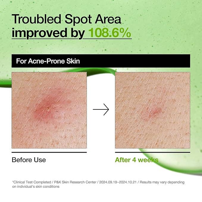 Anua Azelaic Acid 10 Hyaluron Redness Soothing Serum – Gentle Redness Care