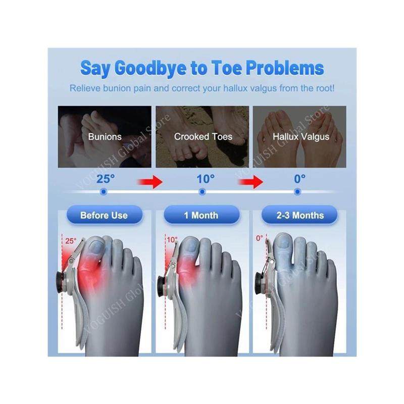 Bunion Corrector Splint – Adjustable Nighttime Hallux Valgus Support