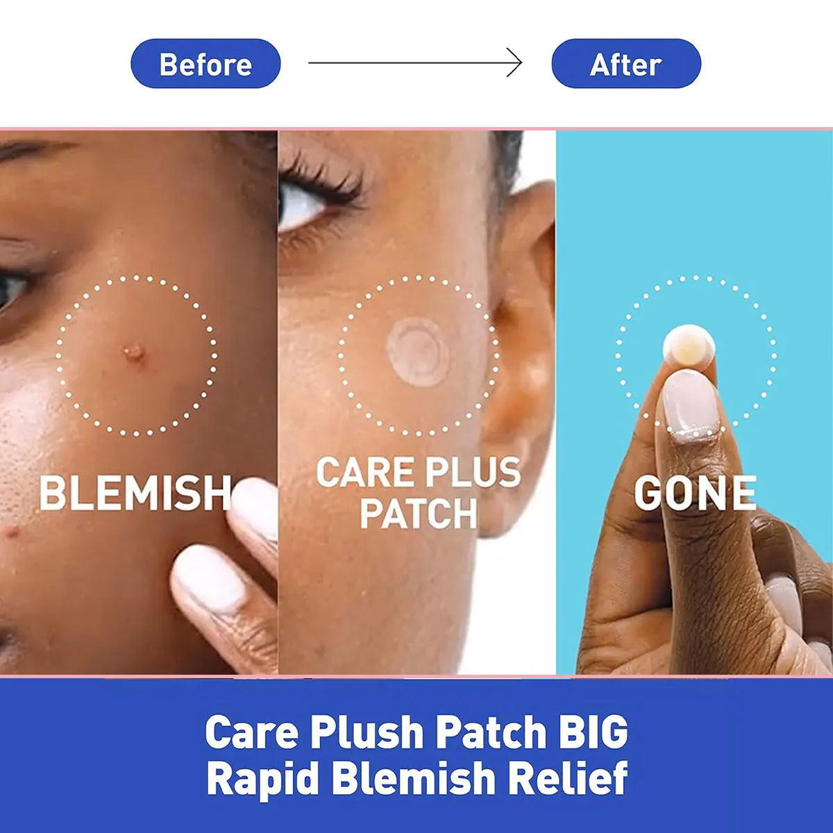 Olive Young Care Plus Spot Cover Spot Patch,Hydrogel Texture,Skin-Conforming,Blemish Skin,Soothing Care,K-Beauty,Korean Makeup